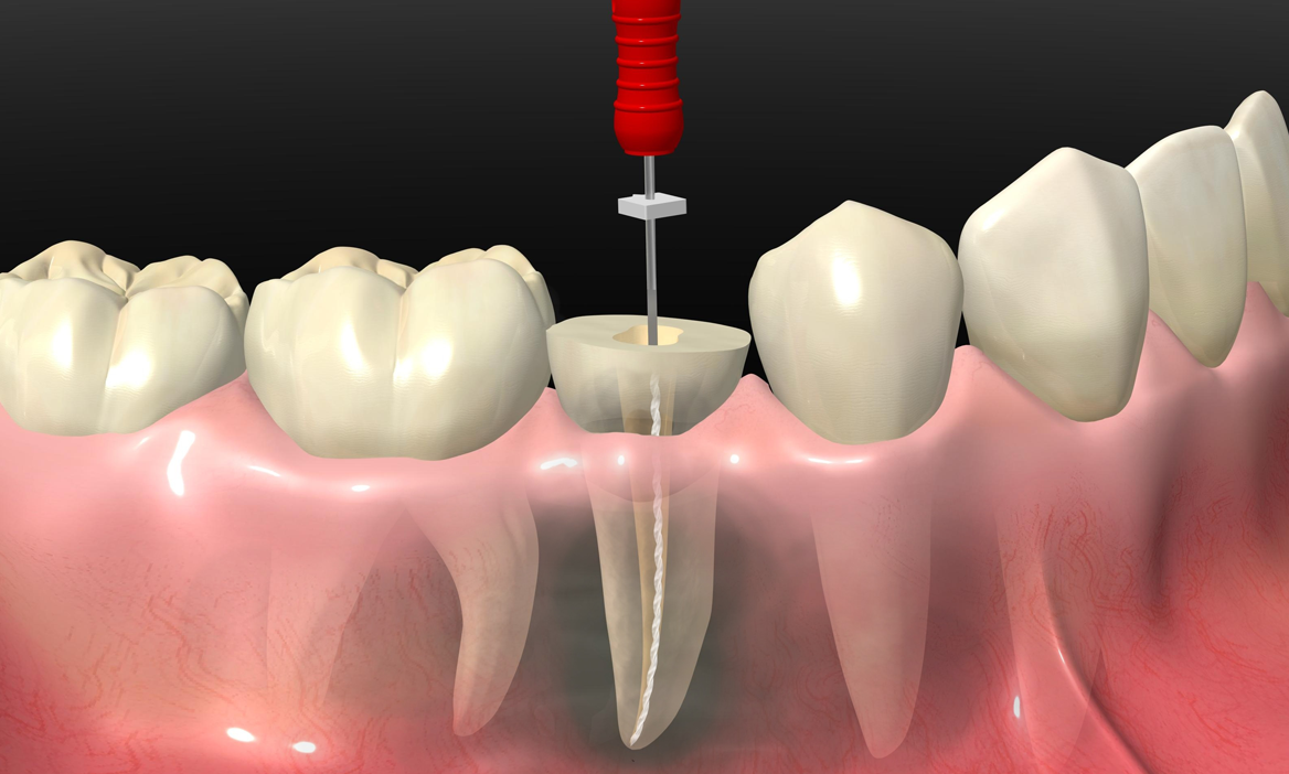 ¿En qué Consiste el Tratamiento de Endodoncia? | Dentalassistance